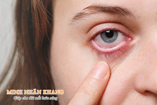 Biểu hiện của bệnh khô mắt là mắt khô, rát, đỏ, cộm xốn.jpg